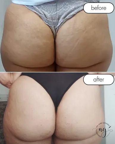 O procedimento também é indicado para reduzir celulites e flacidez, contribuindo para a autoestima das pacientes