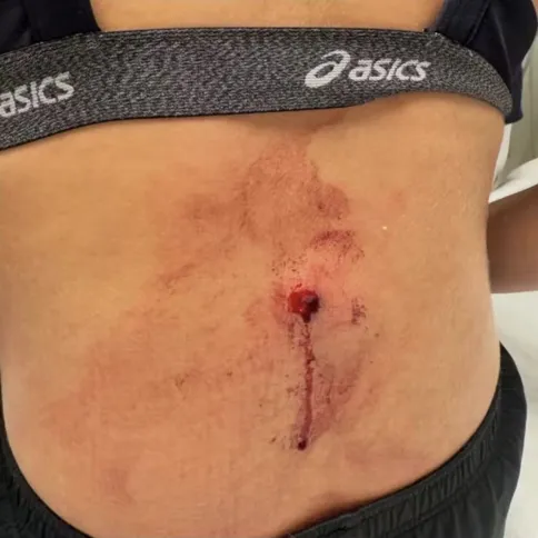 Estado das costas da oposta Júlia Azevedo