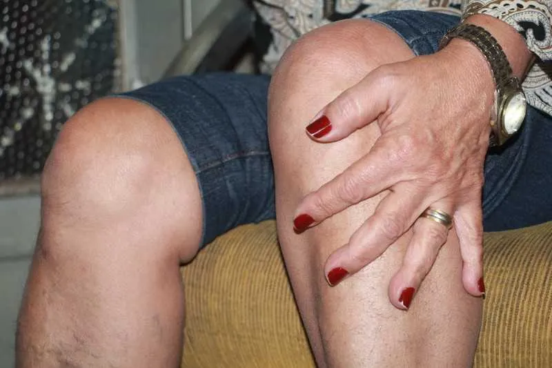 Pacientes relatam dores crônicas nas articulações depois de infectados pelo aedes aegypti