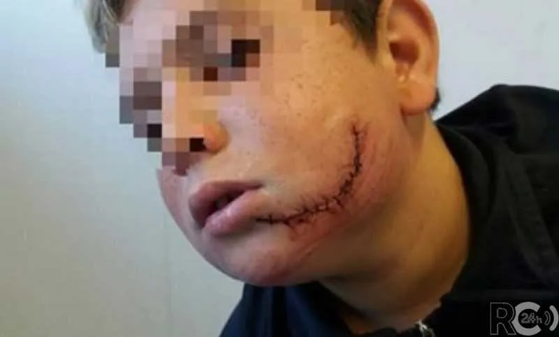  Com o rosto deformado, estudante teve que passar por cirurgia e levou cerca de 50 pontos 