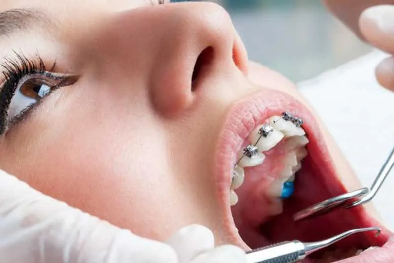 Idade não é empecilho, pois os dentes se movimentam em qualquer período da vida