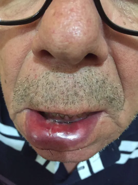 Murilo sofreu um corte na boca e teve que levar pontos
