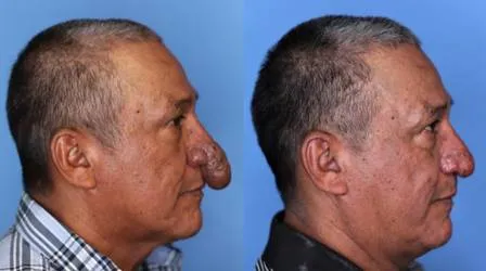 Americano sofre de uma inflação no nariz