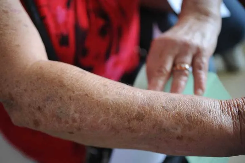 Levantamento do Inca estima que esse ano no Brasil houve 81,66 casos a cada 100 mil homens e 91,98 para 100 mil mulheres
