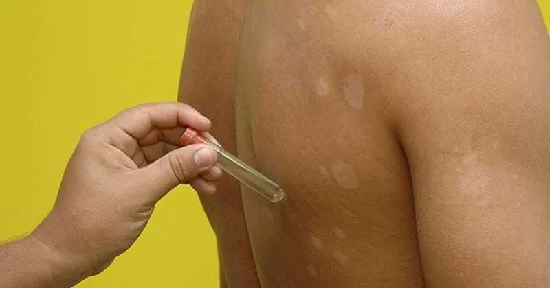 Imagem ilustrativa da imagem Brasil é o segundo país em casos de hanseníase no mundo