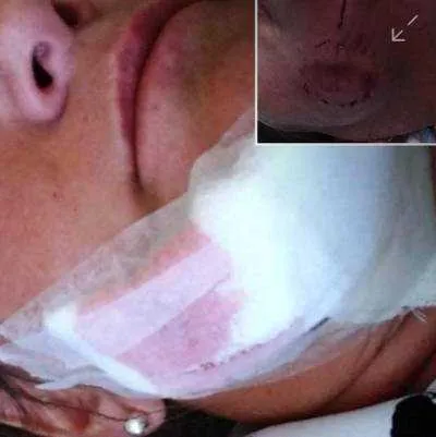 Mulher foi levada para UPA da cidade e levou dez pontos no rosto