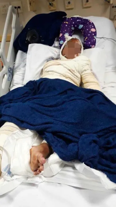 O pequeno Adrian teve 60% do corpo queimado e precisou amputar o braço direito