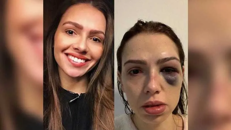 Tatiany Arci perdeu um dente 