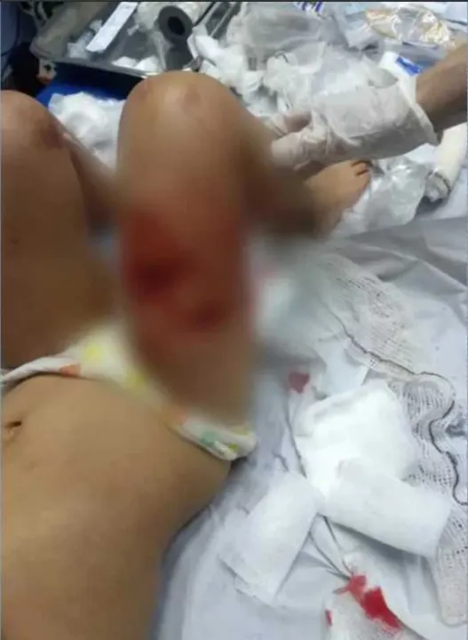 A menina foi mordida na perna e a mãe está com ferimentos nas pernas e na mão direita