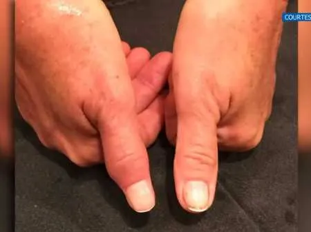 Mulher ficou com o dedo deformado depois da bactéria