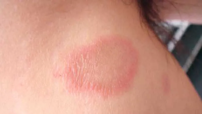 A hanseníase é uma doença infectocontagiosa