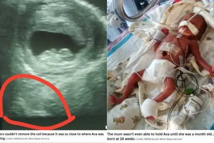 Imagem ilustrativa da imagem Mesmo com anticoncepcional, mulher dá a luz e bebê nasce com DIU na axila