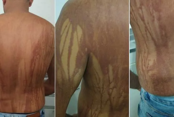 Queimaduras não tem relação com os animais marinhos 