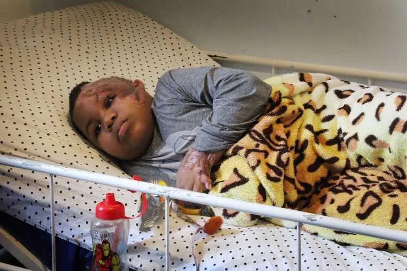 Adrian teve 60% do corpo queimado após ser atingido por fio de alta tensão, no bairro Almerinda, em São Gonçalo