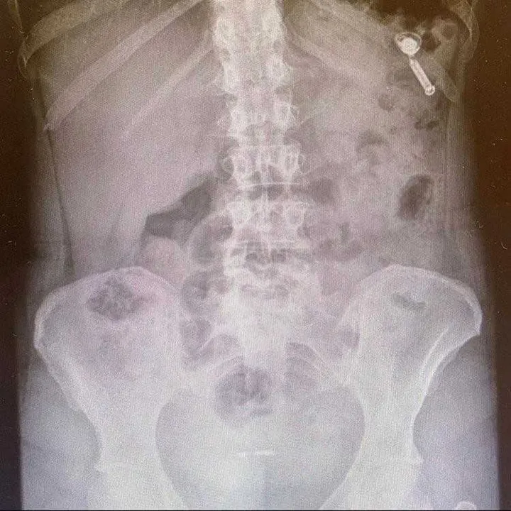 Nas redes sociais, Bel compartilhou a imagem do fone de ouvido ainda em seu intestino 