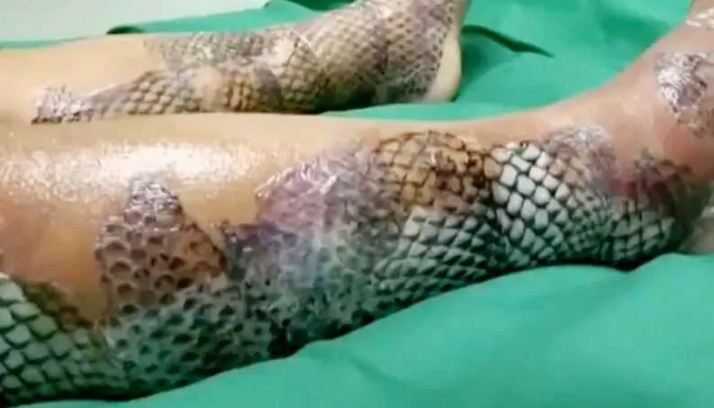Imagem ilustrativa da imagem Pele de tilápia é usada para tratar vítimas de queimaduras em hospital do Rio