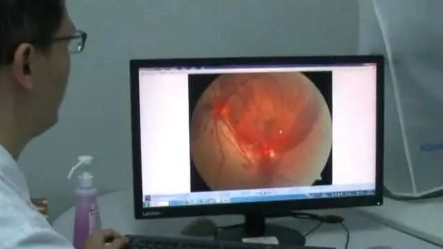 Os resultados dos exames apontaram vários bolsões de sangue na retina impedindo a visão