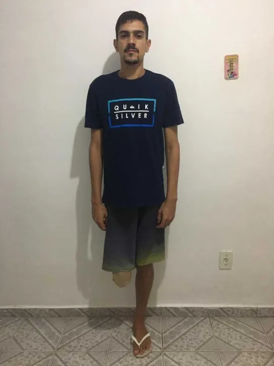 Jovem pede apoio da população para conseguir prótese 