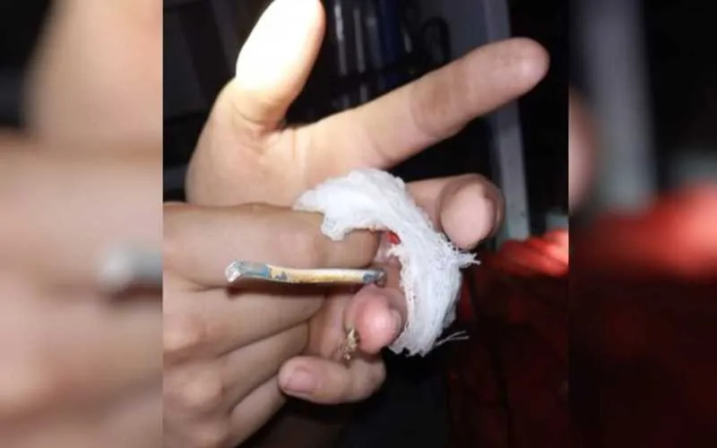 O jovem teve o dedo anelar atravessado por um gancho de suporte de rede