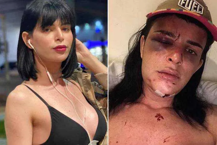 A modelo quebrou  seu maxilar, seu nariz e alguns dentes