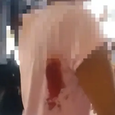 Ferimento por bala perdida foi superficial